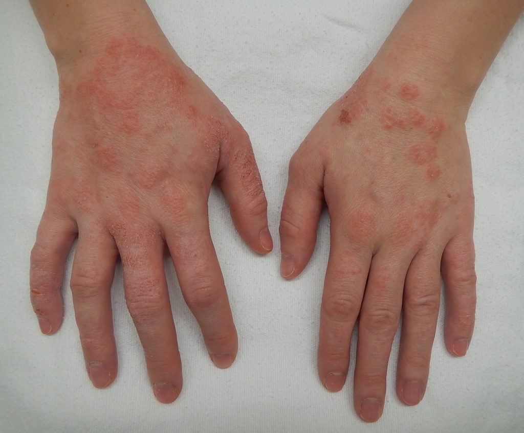 severe eczema on hands