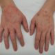 severe eczema on hands