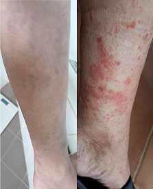 leg before and after Psorclear treatment