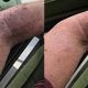 Arm with Psoriasis before and after Psorclear treatment